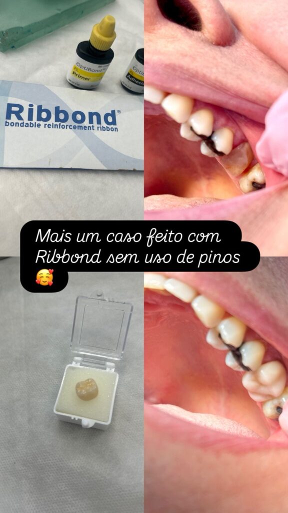 Prótese dentária
